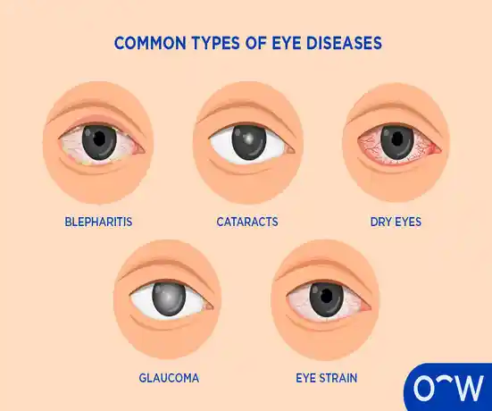 seriously eye concerns